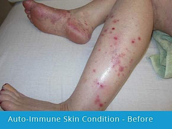 Auto-Immune Skin Condition – Before